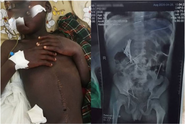 Boy Out of Danger After Surgeons Remove About 50 Needles From His Stomach